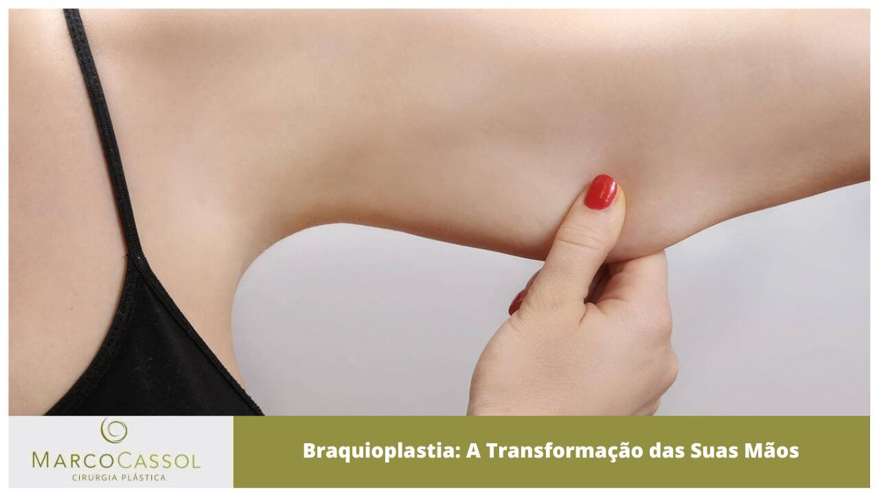 imagem destaque Braquioplastia: A Transformação das Suas Mãos