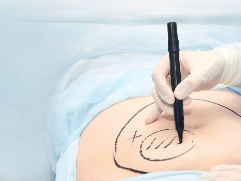 lipoaspiração a laser - cuidados