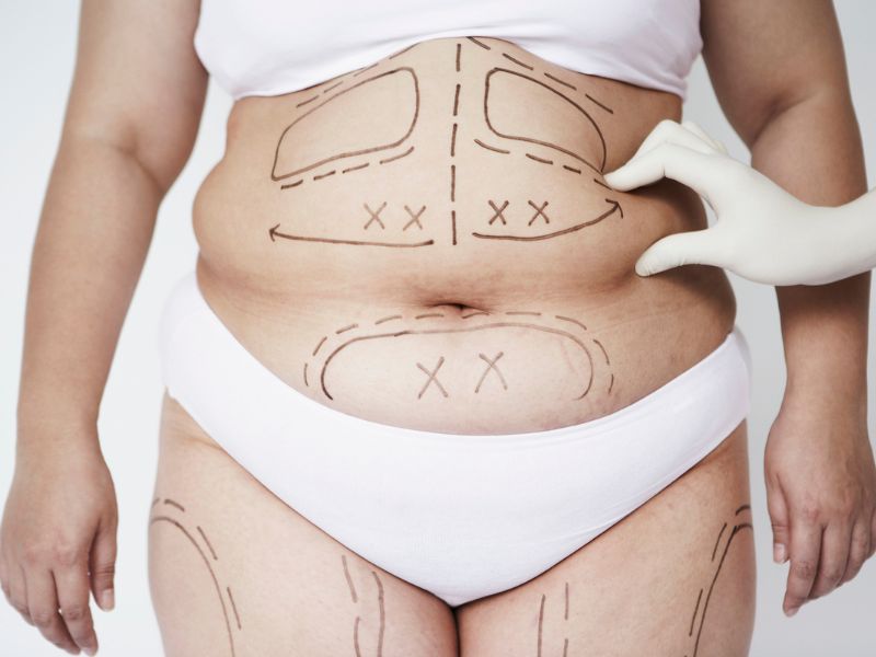 lipoaspiração a laser