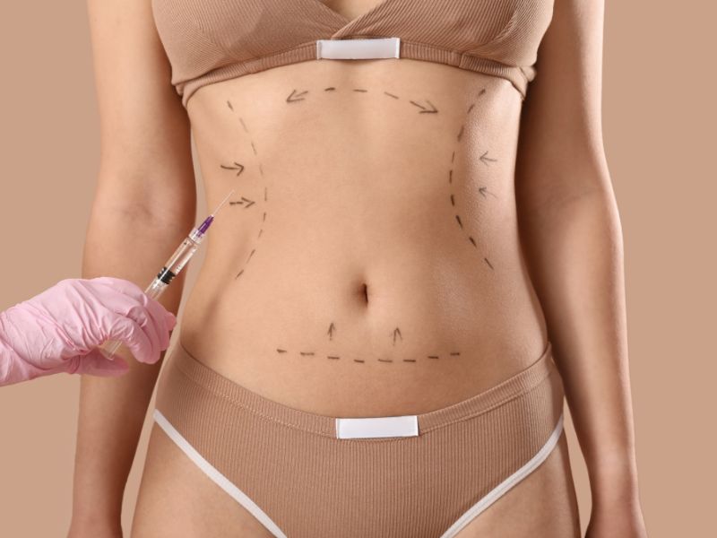 lipoaspiração a laser - vantagens