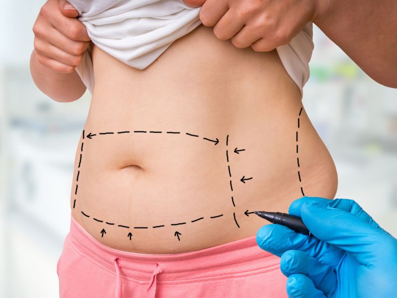 qual o valor de uma lipo na barriga - fatores