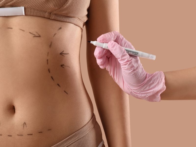 quanto custa uma abdominoplastia com lipo - vale a pena