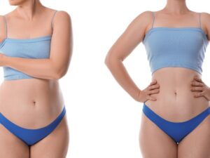 mommy makeover antes e depois