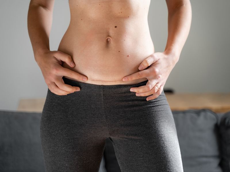 como fica a cicatriz da abdominoplastia - resultado