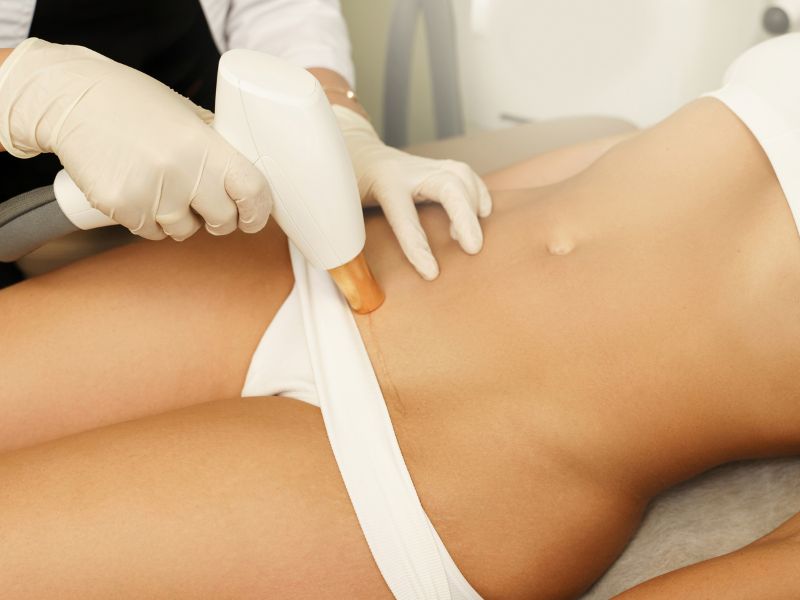 como fica a cicatriz da abdominoplastia - cuidados