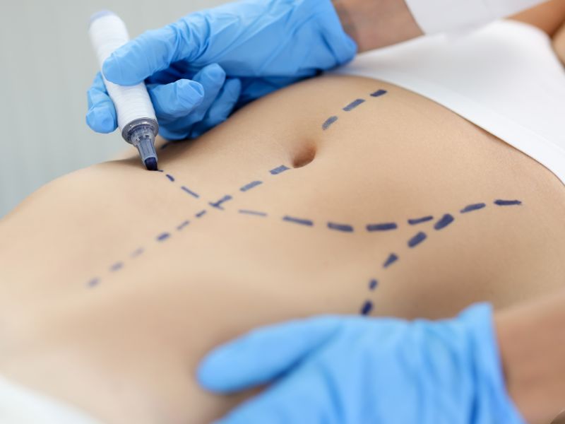 como fica a cicatriz da abdominoplastia - papel