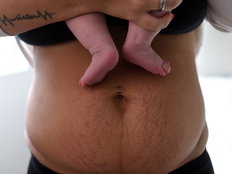 mommy makeover recuperação